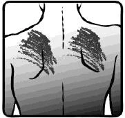 Schematic diagram of the human chest showing two dark, irregular areas located on the lungs to indicate medical regions of interest