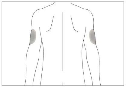 Disegno schematico della schiena di un uomo con due aree grigie che indicano i punti di iniezione sulla parte superiore delle braccia