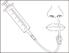Technical drawing of a syringe connected via tubing to a catheter inserted into the nostril of a stylized face with lips and nose