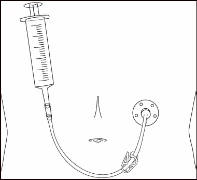 Line drawing of a syringe connected via tubing to an infusion device placed on a person's torso