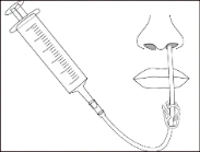 Line drawing of a syringe connected via tubing to a catheter inserted into one nostril and running down toward the mouth