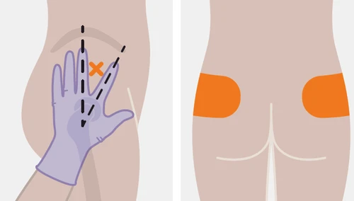 Diagramma medico che mostra una mano guantata che indica l'area di iniezione sul gluteo con una linea tratteggiata e una croce arancione