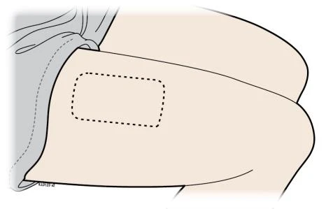 Medical drawing of an arm with a...
