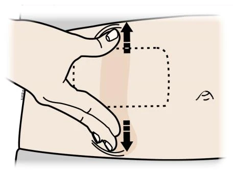 A hand lifting the skin of the...