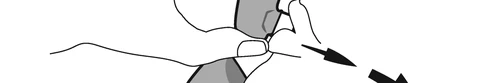 Two hands gripping a gray and white medical device while a black arrow indicates a downward extraction or removal movement