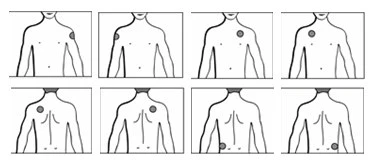 Schema con otto disegni stilizzati di busti umani che indicano i punti di iniezione su braccia, petto, schiena e fianchi