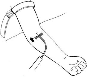 Schematic drawing of an arm with a medical device attached to the skin and a black arrow indicating the direction of movement