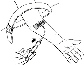 Technical drawing of an arm with a tourniquet and a cannula inserted into a vein while a hand holds a syringe for blood collection