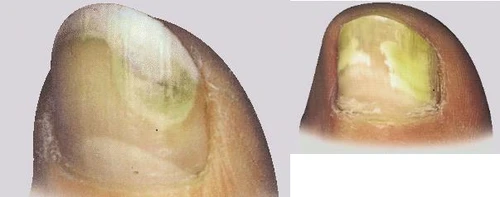Close-up of two human nails with yellowish, thickened, and irregular plates indicating a possible fungal infection or onychomycosis