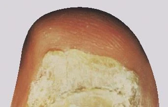 Close-up of a red, inflamed skin area with a large central yellowish, crusted lesion having an irregular texture