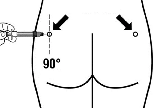 Disegno schematico di una siringa che viene inserita a 90 gradi nel gluteo con frecce nere che indicano i punti di iniezione corretti