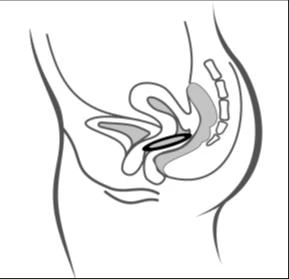 Diagramma anatomico laterale del bacino femminile che mostra l'utero, la vescica, il retto e la posizione di uno spirale intrauterino