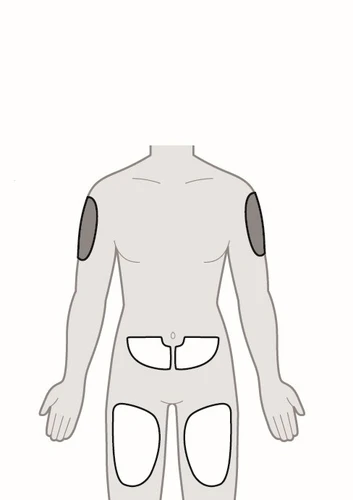Diagramma del corpo umano che mostra aree bianche delimitate su braccia, addome e cosce per indicare i siti di applicazione del farmaco