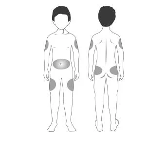 Stylized diagram of a human body viewed front and back with gray patches on shoulders, abdomen, thighs, and buttocks