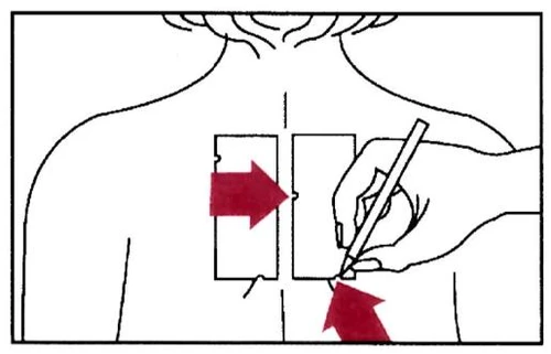 Dibujo esquemático de un torso humano con dos rectángulos en la espalda y una mano que utiliza un bolígrafo para marcar un punto indicado por flechas rojas