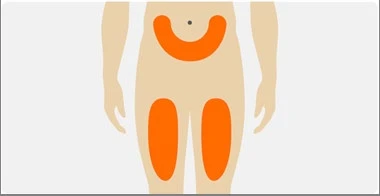 Diagramma di un corpo umano con tre aree arancioni che indicano zone di applicazione sull'addome e sulle cosce destra e sinistra