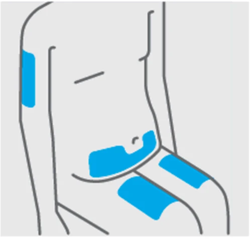 Diagrama esquemático de un torso humano con tres áreas azules que indican los sitios de aplicación del medicamento en el brazo, en el