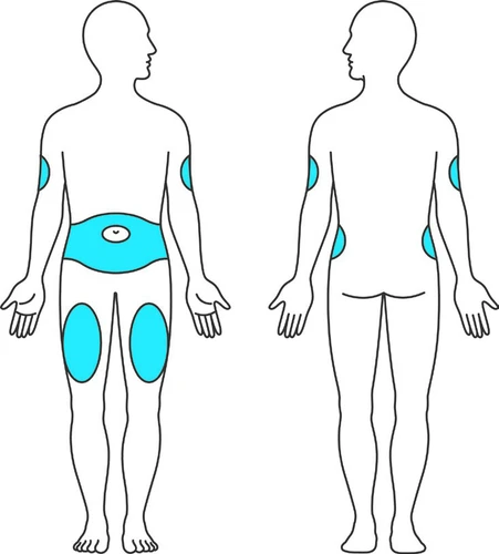 Diagramma di due figure umane stilizzate che mostrano aree azzurre su addome, cosce e braccia per indicare i siti di applicazione del farmaco