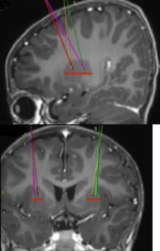 Due scansioni RM del cervello in sezione sagittale e coronale con linee colorate che indicano i punti di inserimento di elettrodi o sensori