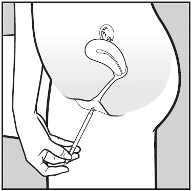 Schematic drawing of a hand inserting a thin applicator into a medical device