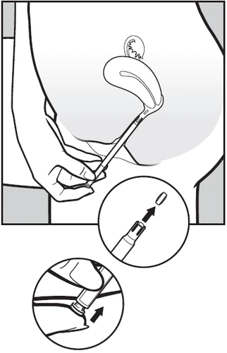 Medical illustration showing the insertion of a thin medical device under the skin
