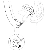 Schematic drawing showing a hand inserting an applicator into the vaginal canal and a detail of the hand pressing the device