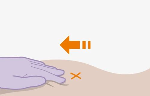 Medical illustration with a gloved hand pressing on the skin next to an orange cross and an arrow indicating lateral direction