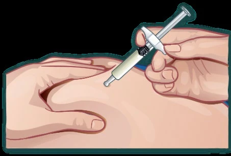 A hand holding a syringe with a needle and plunger injecting medication into the subcutaneous fatty tissue of the