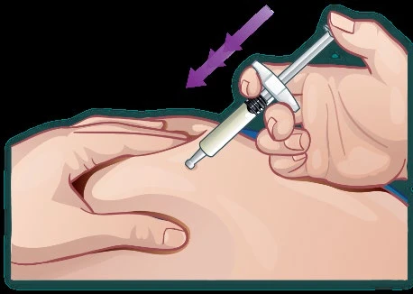 A hand holding a syringe inserting it into the subcutaneous tissue of the