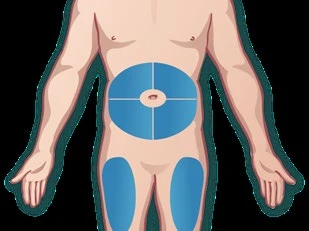 Medical illustration of a male torso with highlighted blue areas on the