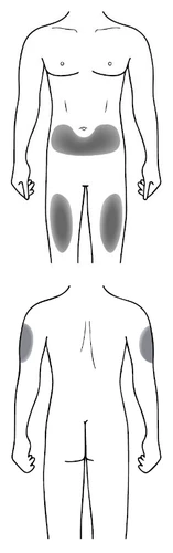Schematic representation of a human body showing gray areas for
