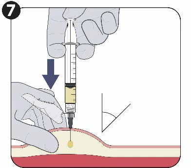 Medical illustration showing a hand holding a syringe to inject a liquid into an angled skin flap at a specific angle