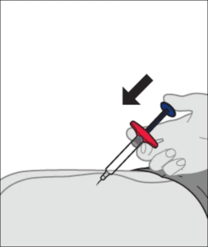 A hand holds a syringe with a red and blue grip to inject liquid into the skin of the body with a black arrow indicating the movement