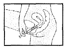 Disegno schematico che mostra l'inserimento di un ago in una zona del corpo con indicazione dell'angolazione e della profondità del trattamento