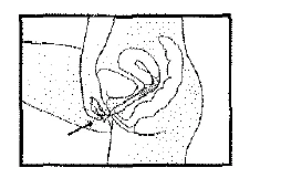 Disegno schematico in bianco e nero che mostra la sezione anatomica di un orecchio con una freccia che indica il condotto uditivo esterno