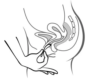 Schematic line drawing of a hand inserting an applicator into the vaginal canal of a woman in a side-lying position