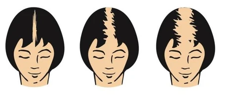 Tre schemi del volto di una donna con capelli neri che mostrano una progressiva calvizie, da una sottile linea fino a una grande macchia chiara sulla sommità del capo