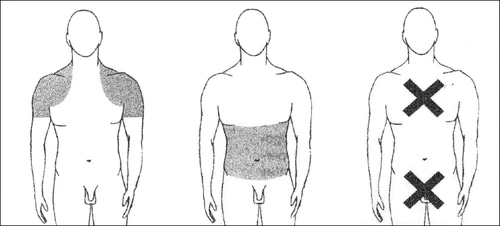 Tres esquemas del torso masculino que muestran los sitios de aplicación: brazos sombreados, abdomen sombreado y dos cruces negras en el tórax y en la región infraabdominal