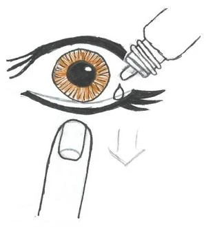 Illustration showing a brown eye with a drop of medication falling from a bottle, and below the eye a finger and a downward arrow