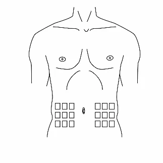Representación esquemática de un torso masculino con dos filas de cuadrados marcados a ambos lados del ombligo en la parte inferior del abdomen