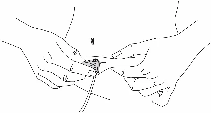 Ilustración que muestra dos manos sosteniendo y preparando un pequeño parche cuadrado con perforaciones en el abdomen de una persona, cerca del ombligo