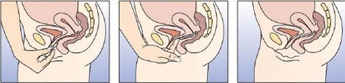 Trzy schematy anatomiczne pokazujące dłoń wprowadzającą aplikator do pochwy w celu podania leku w pozycji leżącej na boku