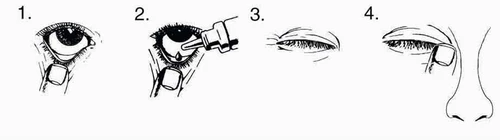 Instrucción de cuatro pasos para la aplicación de gotas oculares: ojo abierto, aplicación de las gotas con cuentagotas, ojo cerrado y limpieza del párpado con una toallita