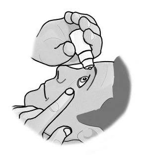 Una mano sostiene un pequeño recipiente blanco y aplica gotas oculares a una persona, mientras que la otra mano tira suavemente del párpado inferior para facilitar la aplicación del medicamento