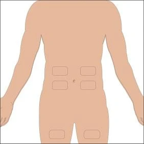 A schematic human figure with four rectangular areas marked on the abdomen and two on the thighs, indicating injection sites