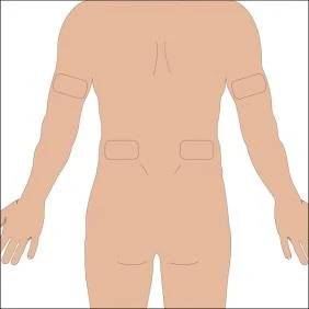A schematic silhouette of the human torso from the back, with rectangular areas marked on both arms and the lower back