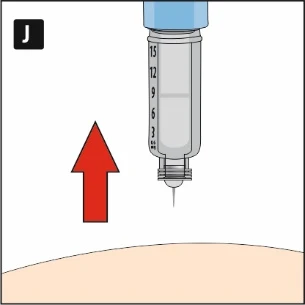 Syringe with needle pointed vertically downward over skin, red arrow indicating upward movement of the syringe, letter J in the upper left corner