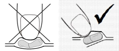 Schema che mostra l'applicazione errata della capsula sulla piega cutanea con una grande X rossa e la corretta posizione della capsula su una superficie piatta con un uccellino