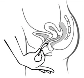 An anatomical diagram of female pelvic organs showing a hand inserting a tampon into the vagina in a lateral profile view