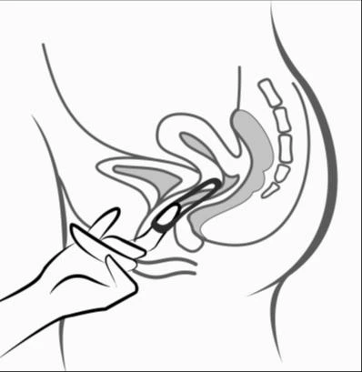 A schematic illustration showing a hand inserting an applicator into the vaginal canal of a woman in a lateral cross-sectional view of the pelvis and reproductive organs